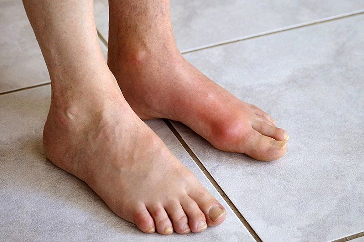 Hình ảnh bệnh nhân bị gout thường thấy hiện nay