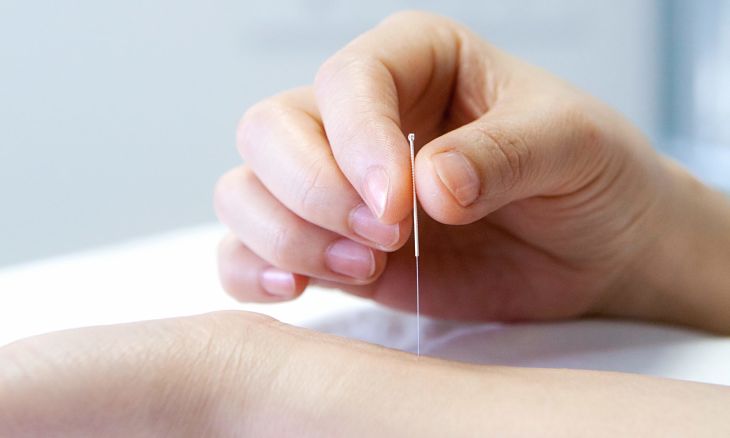 Châm cứu huyệt có tác dụng điều trị đau đầu, liệt mặt
