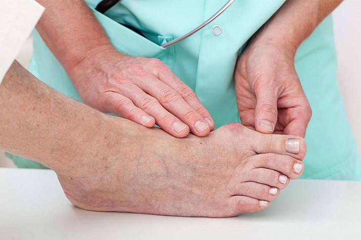 Hạt tophi xuất hiện tại ổ khớp chứng tỏ bạn đã bị gout mãn tính