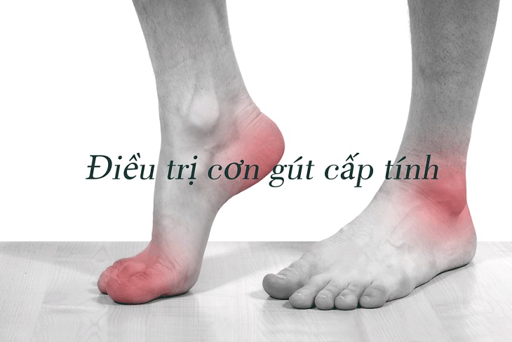 Phác đồ điều trị gout cấp phải dựa trên chuẩn của Bộ Y tế