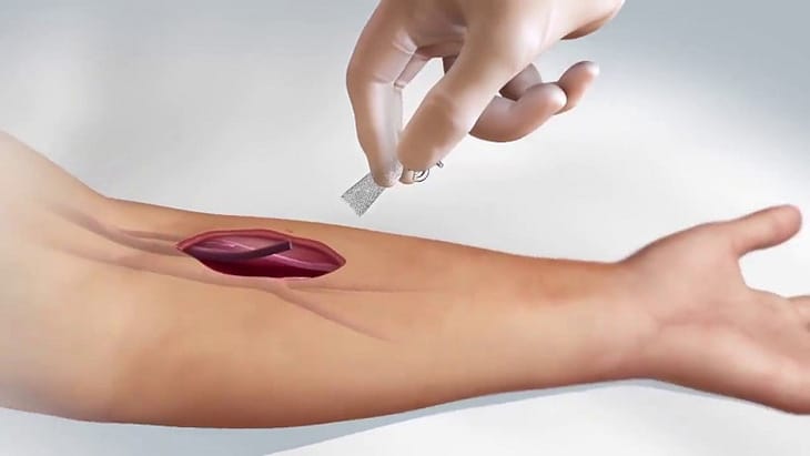 Người bệnh cần chuẩn bị kỹ trước khi tiến hành chạy thận