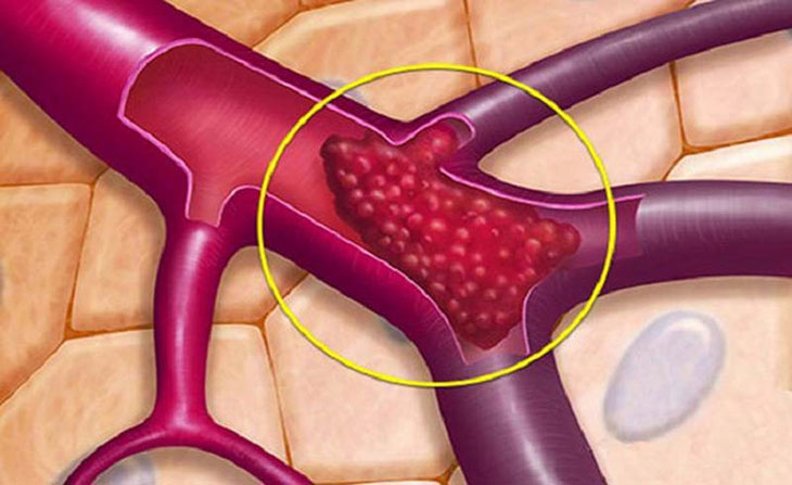 Thông tim cũng tồn tại những rủi ro nhất định
