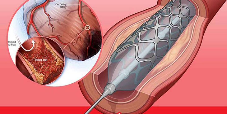 Xét nghiệm luồng trong trong tim rất hữu ích trong y học