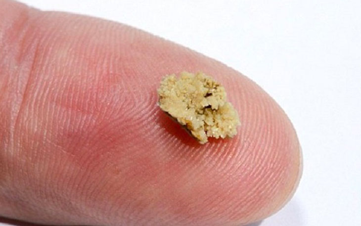 Có nhiều cách chữa sỏi thận 6mm