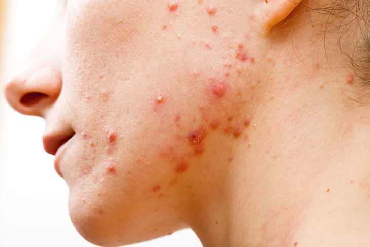 Người gặp các vấn đề về da có nguy cơ mắc bệnh