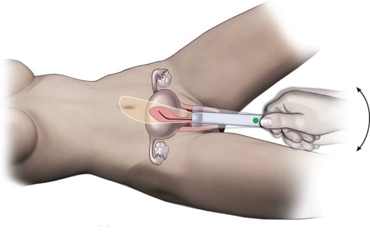Siêu âm đầu dò được áp dụng cho những phụ nữ đã quan hệ tình dục