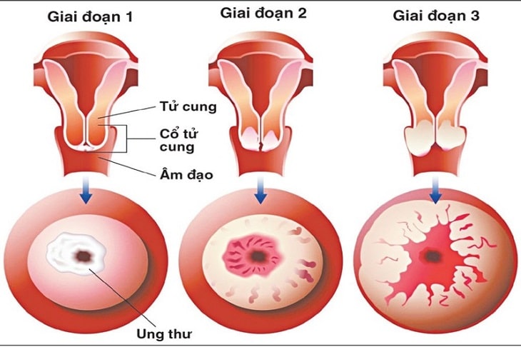 Ung thư tử cung là một bệnh lý phụ khoa nguy hiểm