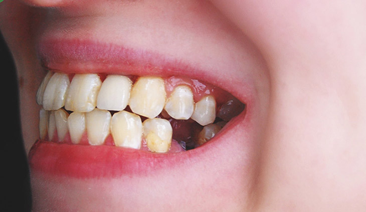 Mất răng có thể gây tác động tới dây thần kinh