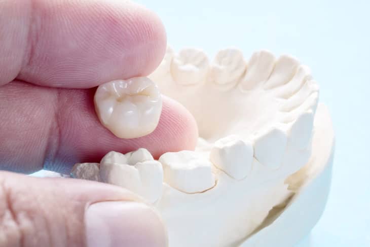 Có nhiều yếu tố tác động tới  việc trồng răng sứ mất bao lâu