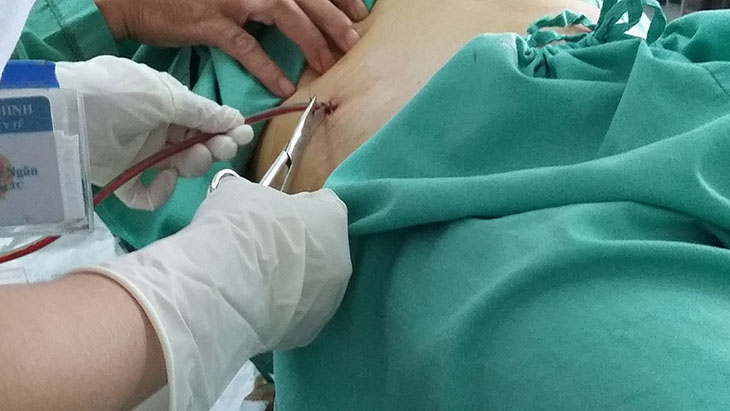 Cần chuẩn bị ống dẫn lưu để làm thủ thuật