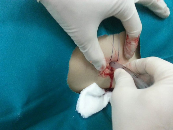 Người bệnh có thể gặp phải một số biến chứng sau thủ thuật