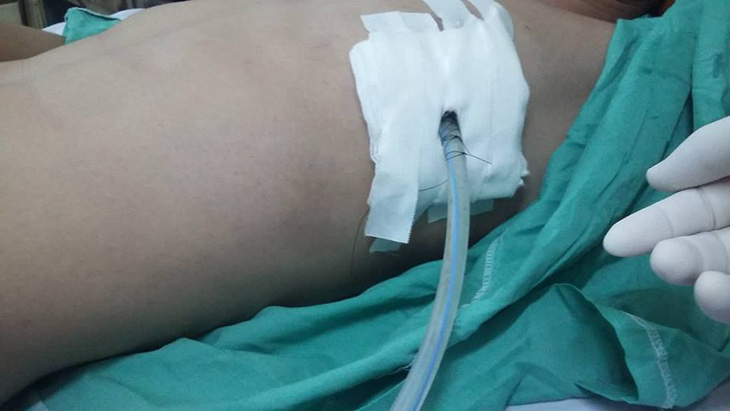 Các bước thực hiện kỹ thuật mở màng phổi tối thiểu
