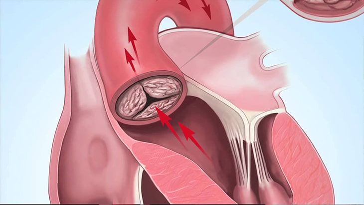 Thông liên nhĩ gặp nhiều ở bệnh nhân tim bẩm sinh