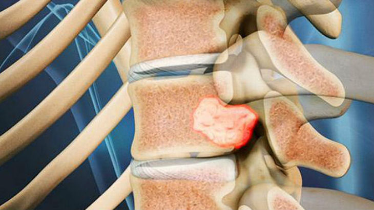 U cột sống cũng là bệnh lý khá phổ biên