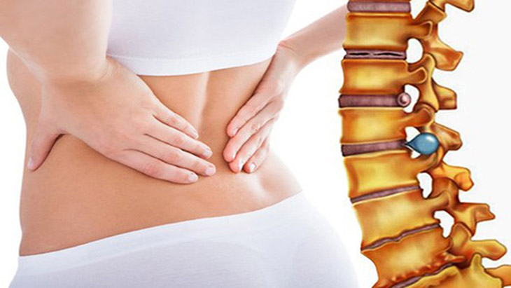 Thoát vị đĩa đệm gây nhiều khó khăn cho bệnh nhân