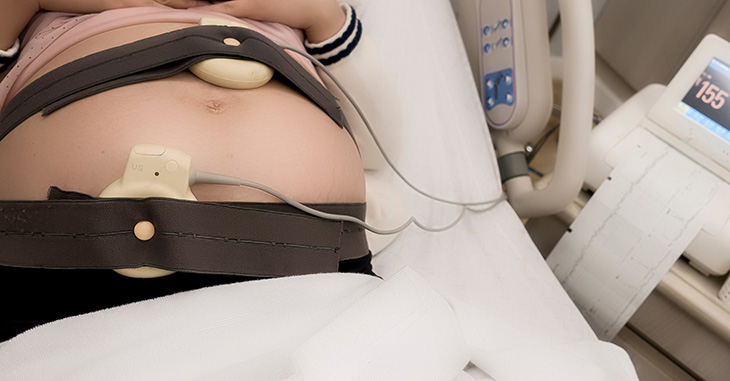 Đứng trước một NST không đáp ứng, cần thiết phải loại trừ tình tình trạng ngủ của thai