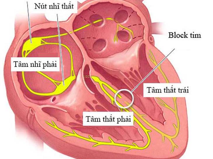 điện tâm đồ trong hội chứng nút xoang bệnh lý