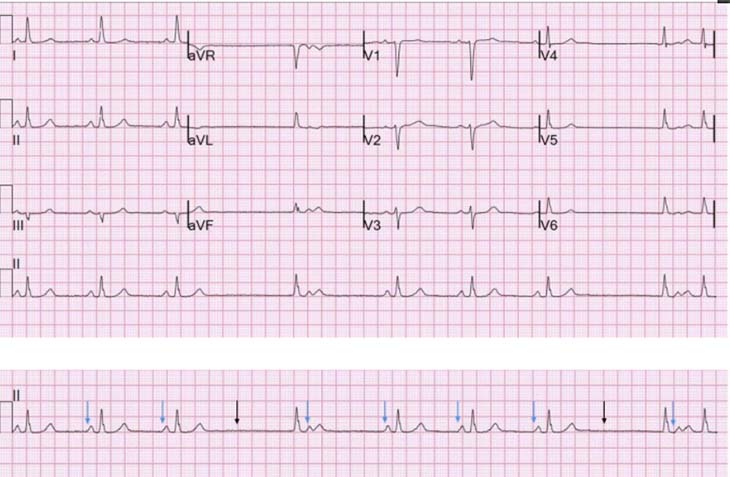 điện tâm đồ trong hội chứng nút xoang bệnh lý