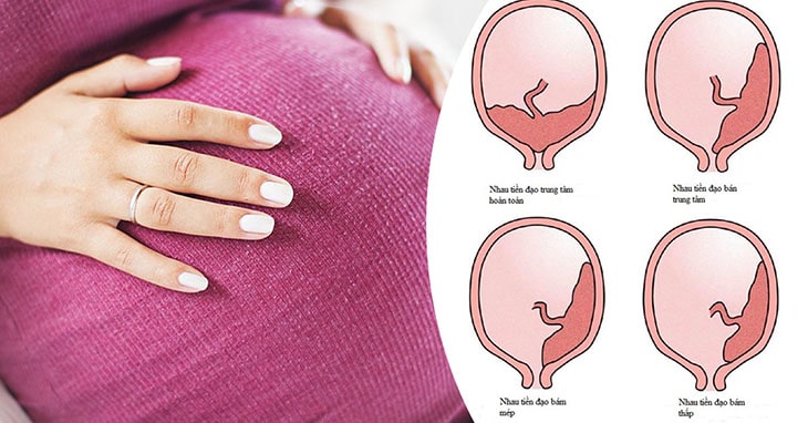 Phá thai muộn có thể gây nhau tiền đạo vô cùng nguy hiểm