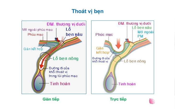 Cách phân biệt thoát vị trực tiếp và gián tiếp