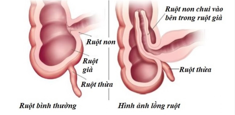 Bệnh lồng ruột là hiện tượng một đoạn ruột chui vào lòng một đoạn ruột khác