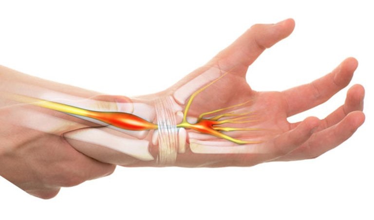 Các bệnh thần kinh cơ được xem là những bệnh có ảnh hưởng tới cơ bắp