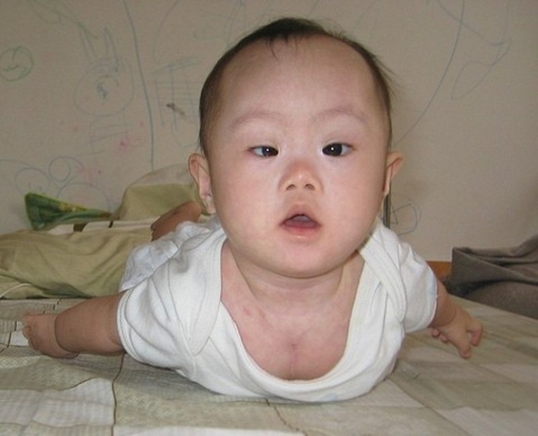 Bệnh nhược cơ làm ảnh hưởng tới mắt