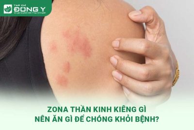 benh-zona-than-kinh-kieng-gi