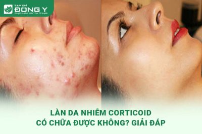 da-nhiem-corticoid-co-chua-duoc-khong