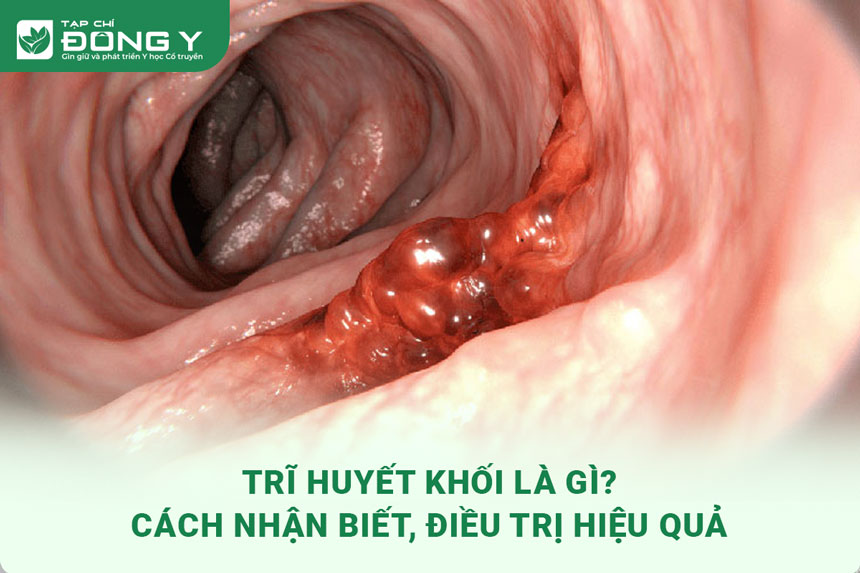 tri huyet khoi