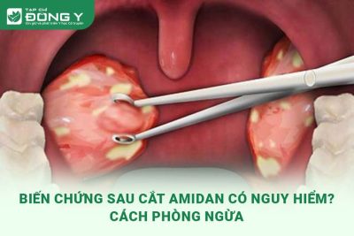 bien-chung-sau-cat-amidan