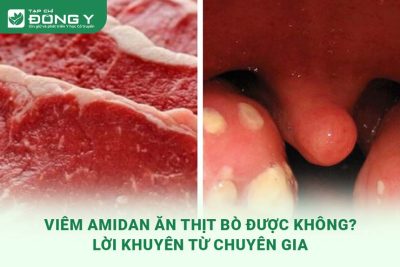 viem-amidan-an-thit-bo-duoc-khong