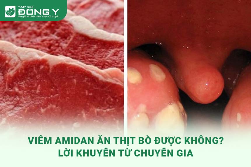 viem-amidan-an-thit-bo-duoc-khong