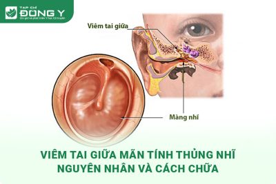 viem tai giua man tinh thung nhi