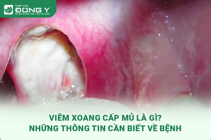 viem xoang cap mu