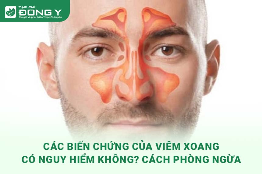cac-bien-chung-cua-viem-xoang
