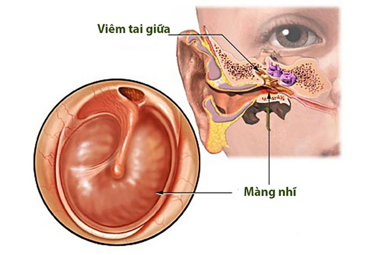 viem tai giua man tinh thung nhi