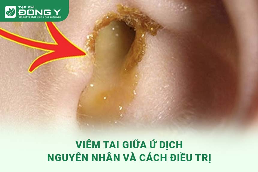 viem-tai-giua-u-dich