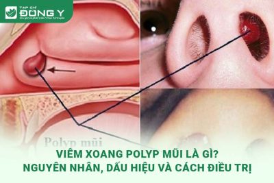 viem-xoang-polyp-mui