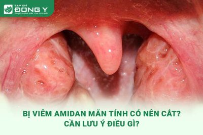 viem-amidan-man-tinh-co-nen-cat