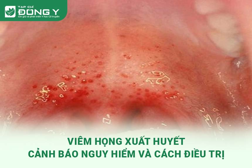 viem-hong-xuat-huyet