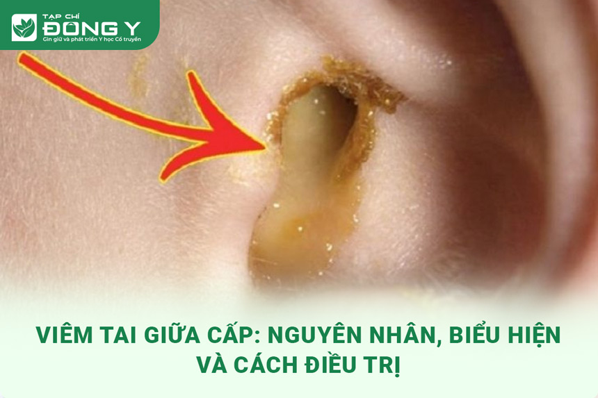 viem-tai-giua-cap