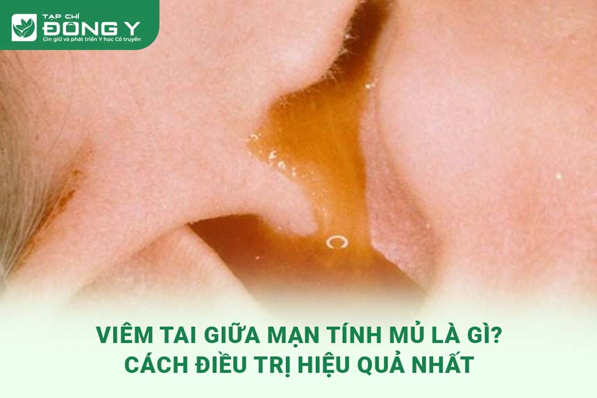 viem-tai-giua-man-tinh-mu