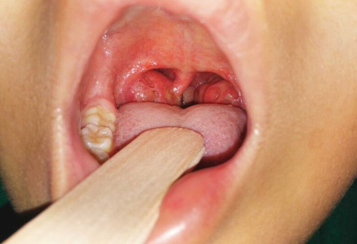 Bác sĩ quan sát trực tiếp amidan để chẩn đoán bệnh
