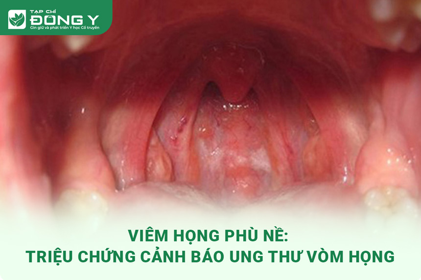 Viêm Họng Phù Nề: Triệu Chứng Cảnh Báo Ung Thư Vòm Họng