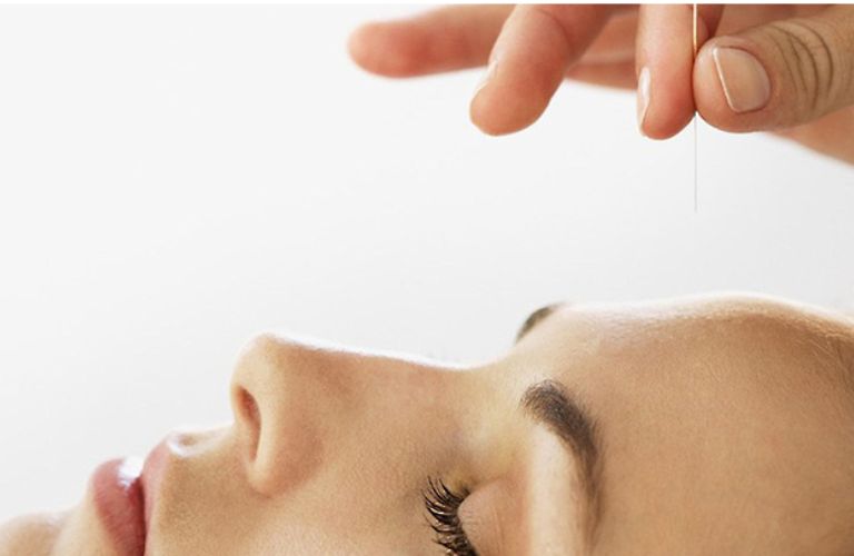 Phương pháp cấy chỉ tác động trực tiếp vào nhóm huyệt vị liên hệ mật thiết với vùng mũi