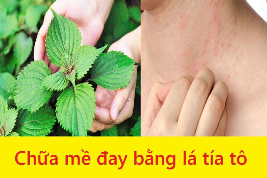 Chữa mề đay bằng lá tía tô đơn giản mà an toàn
