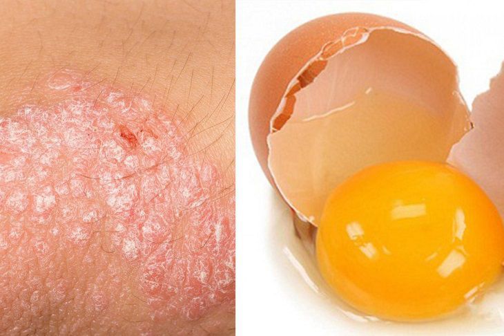 Lòng đỏ trứng gà chữa vảy nến hiệu quả