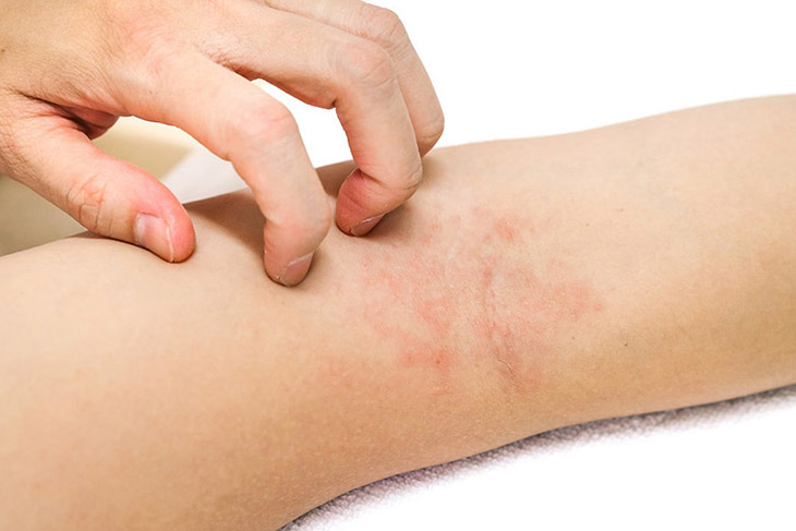 Lá tía tô cho hiệu quả trên thể bệnh nhẹ