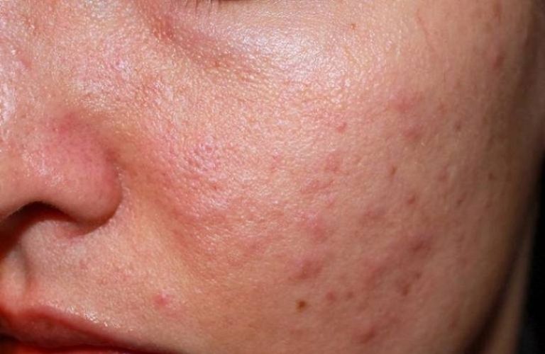 Da mặt sần sùi, ngứa ngáy có biểu hiện thế nào